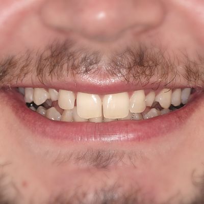 Dental Bonding - Smile 2 before